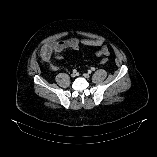 Acute appendicitis (Radiopaedia 79950-93224 Axial C+ portal venous phase 75).jpg