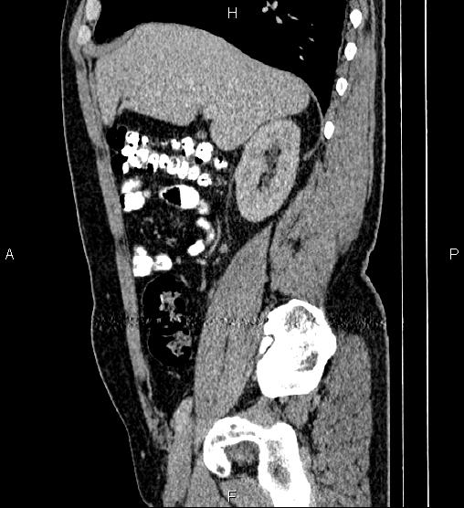 File:Acute appendicitis (Radiopaedia 84780-100240 Sagittal C+ portal venous phase 32).jpg