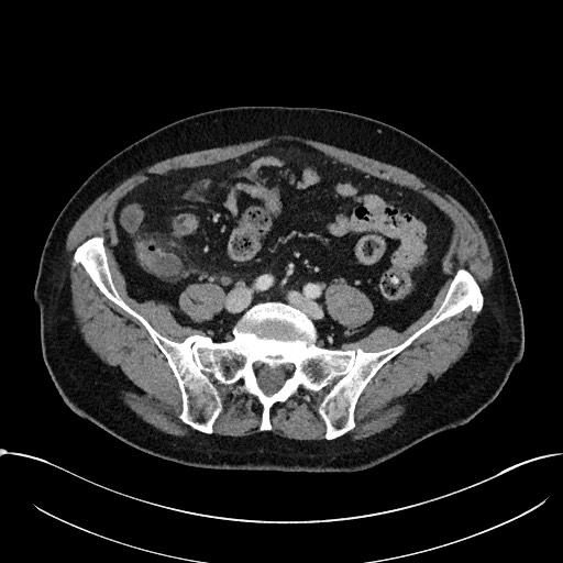 File:Acute appendicitis - large appendicoliths (Radiopaedia 61805-69820 Axial C+ portal venous phase 90).jpg