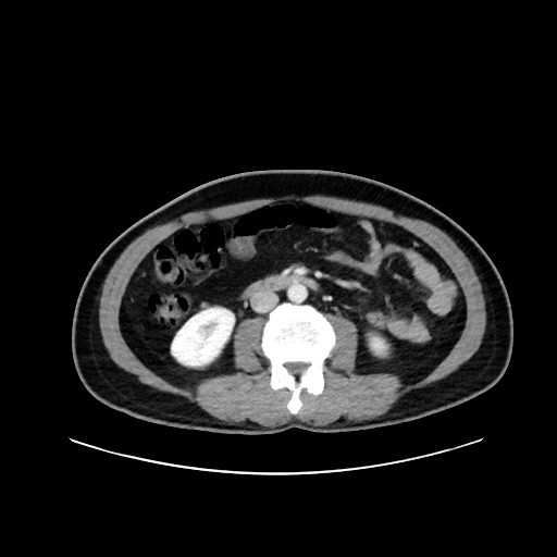 File:Acute appendicitis and COVID 19 pneumonia (Radiopaedia 76604-88380 Axial C+ portal venous phase 40).jpg