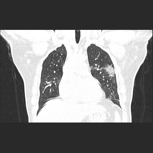 Acute appendicitis and COVID 19 pneumonia (Radiopaedia 76604-88380 G 26).jpg