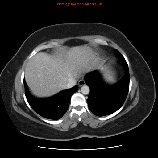 Acute appendicitis complicated by ovarian vein thrombophlebitis (Radiopaedia 16172-15851 Axial C+ portal venous phase 17).jpg