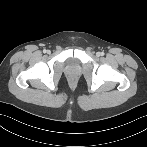 Acute appendicitis with appendicoliths (Radiopaedia 50186-55532 Axial C+ portal venous phase 83).png