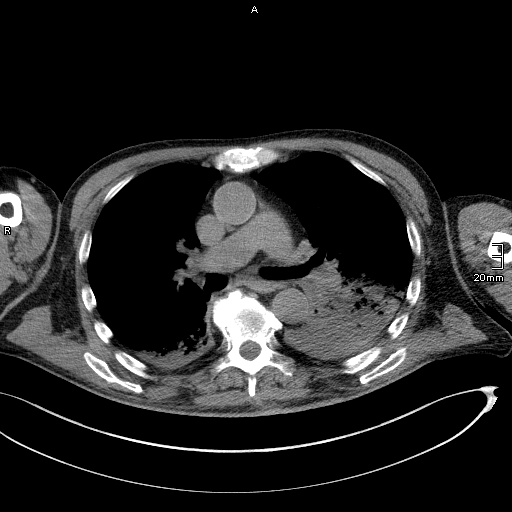Acute aspiration pneumonitis (Radiopaedia 55642-62166 Axial liver window 29).jpg