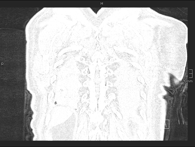 Acute aspiration pneumonitis (Radiopaedia 55642-62166 Coronal lung window 95).jpg