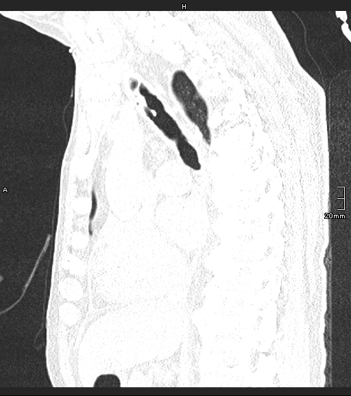 Acute aspiration pneumonitis (Radiopaedia 55642-62166 Sagittal lung window 83).jpg