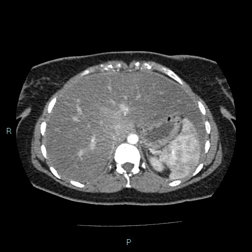 Acute bilateral pyelonephritis (Radiopaedia 37146-38881 Axial C+ arterial phase 30).jpg