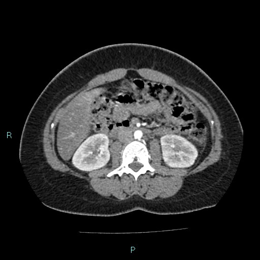 Acute bilateral pyelonephritis (Radiopaedia 37146-38881 Axial C+ arterial phase 90).jpg