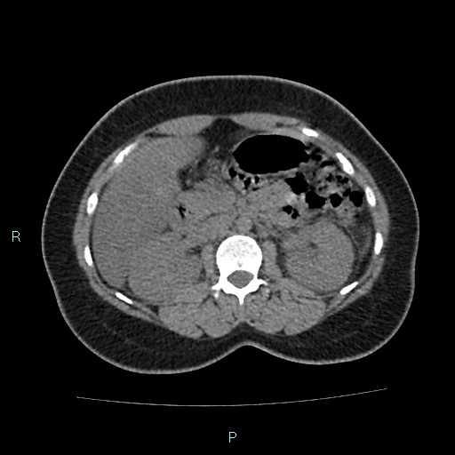 Acute bilateral pyelonephritis (Radiopaedia 37146-38881 Axial non-contrast 42).jpg