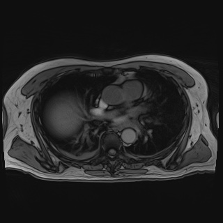 Acute cholecystitis (Radiopaedia 72392-82923 Axial T1 out-of-phase 6).jpg