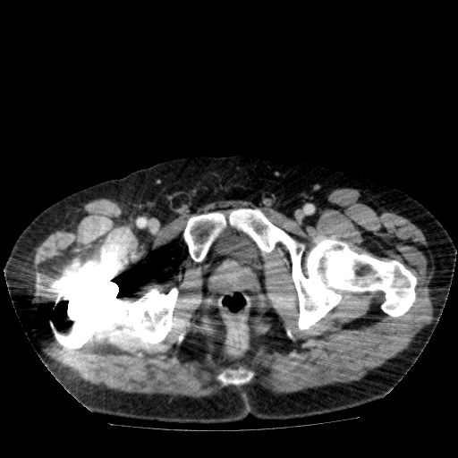 File:Acute cholecystitis and incidental left sided IVC (Radiopaedia 49352-54459 Axial C+ portal venous phase 154).jpg