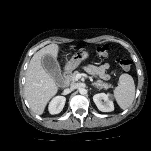 Acute cholecystitis and incidental left sided IVC (Radiopaedia 49352-54459 Axial C+ portal venous phase 55).jpg