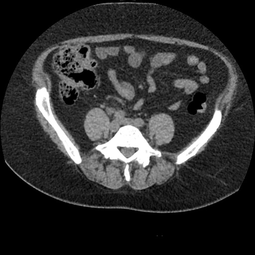 File:Acute cholecystitis and ureteric colic (Radiopaedia 42330-45444 Axial prone 68).jpg