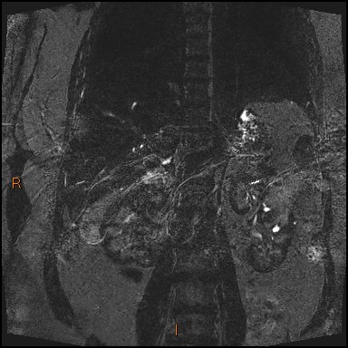 File:Acute cholecystitis with gallbladder neck calculus (Radiopaedia 42795-45971 Coronal Turbo spin echo 5).jpg