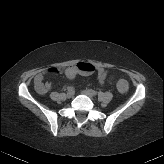 Acute colonic hemorrhage in ulcerative colitis (Radiopaedia 77415-89538 Axial non-contrast 94).jpg