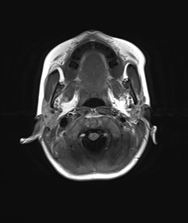 File:Acute disseminating encephalomyelitis with bilateral optic neuritis (Radiopaedia 79676-92886 Axial T1 2).jpg