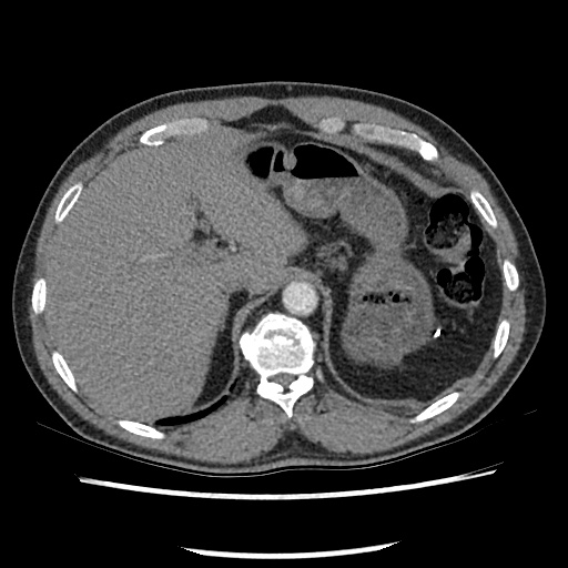 Acute epicardial fat necrosis (Radiopaedia 42327-45440 Axial C+ CTPA 86).jpg