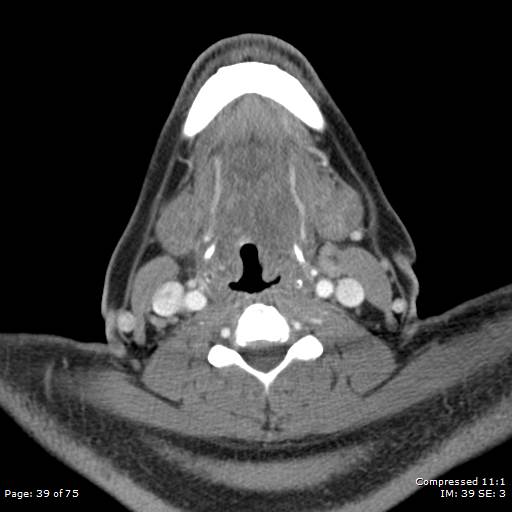 Acute epiglottitis (Radiopaedia 54375-60590 Axial C+ arterial phase 39).jpg