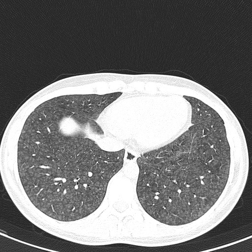 File:Acute hypersensitivity pneumonitis (Radiopaedia 85293-100870 Axial lung window 92).jpg