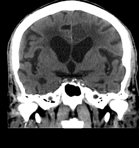 Acute left anterior cerebral artery territory infarction (Radiopaedia 51785-57578 Coronal non-contrast 28).jpg