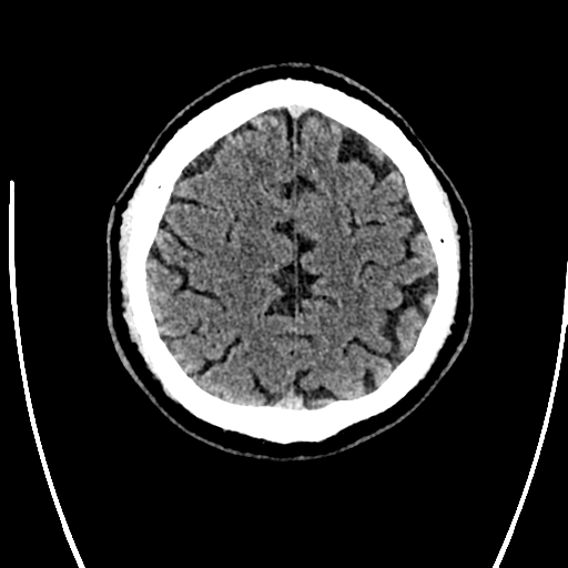 Acute left middle cerebral artery territory ischemic stroke (Radiopaedia 35688-37223 Axial non-contrast 66).png