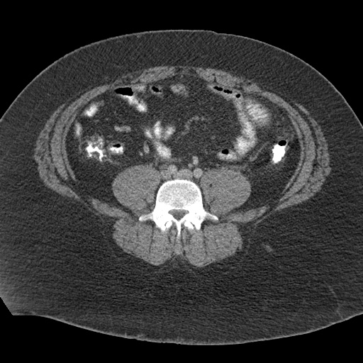 File:Acute mesenteric venous ischemia (Radiopaedia 46041-50383 Axial C+ portal venous phase 87).jpg