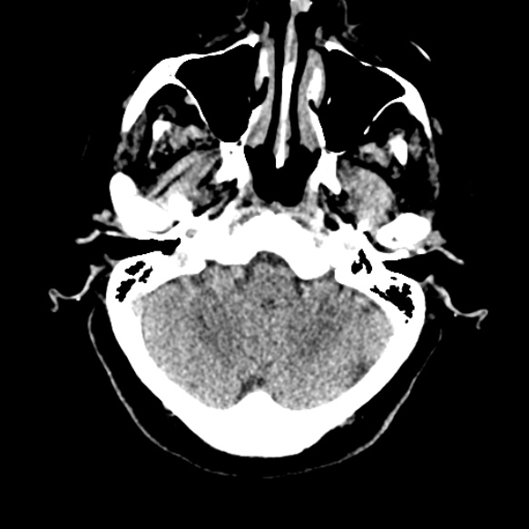 Acute middle cerebral artery territory infarct (Radiopaedia 52380-58283 Axial non-contrast 15).jpg