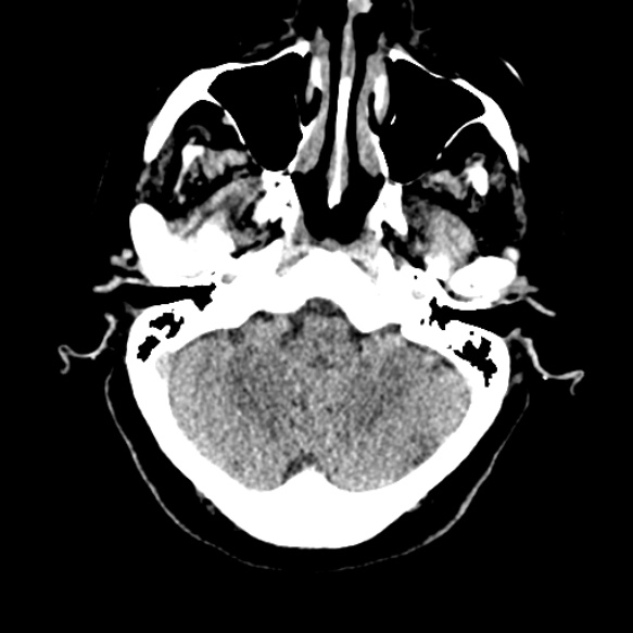 Acute middle cerebral artery territory infarct (Radiopaedia 52380-58283 Axial non-contrast 16).jpg