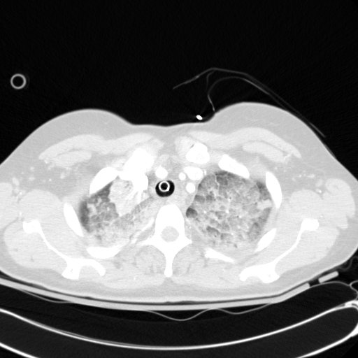 Acute myocardial infarction in CT (Radiopaedia 39947-42415 Axial lung window 19).jpg
