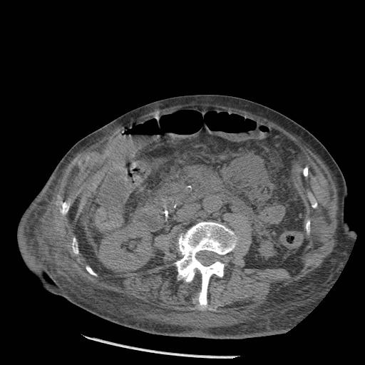 Acute on chronic pancreatitis (Radiopaedia 13233-13244 Axial non-contrast 51).jpg