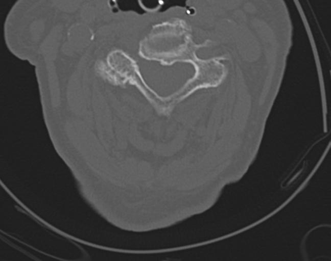 Acute on chronic subdural hematoma and thoracic vertebral injury in a multitrauma patient (Radiopaedia 31698-32619 Axial bone window 28).jpg