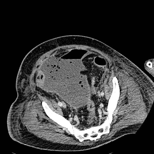 Acute pancreatic necrosis (Radiopaedia 13560-18501 Axial C+ portal venous phase 122).jpg