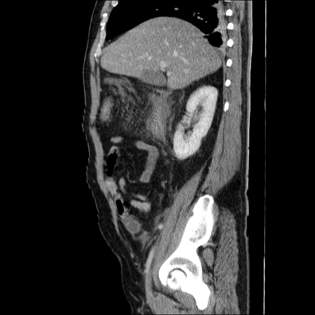 Acute pancreatitis (Radiopaedia 26663-26813 Sagittal C+ portal venous phase 24).jpg