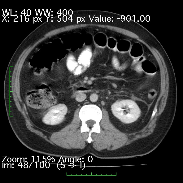 Acute pancreatitis (Radiopaedia 34043-35276 Axial C+ portal venous phase 48).jpg