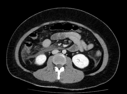 Acute pancreatitis (Radiopaedia 69236-79012 Axial C+ portal venous phase 47).jpg