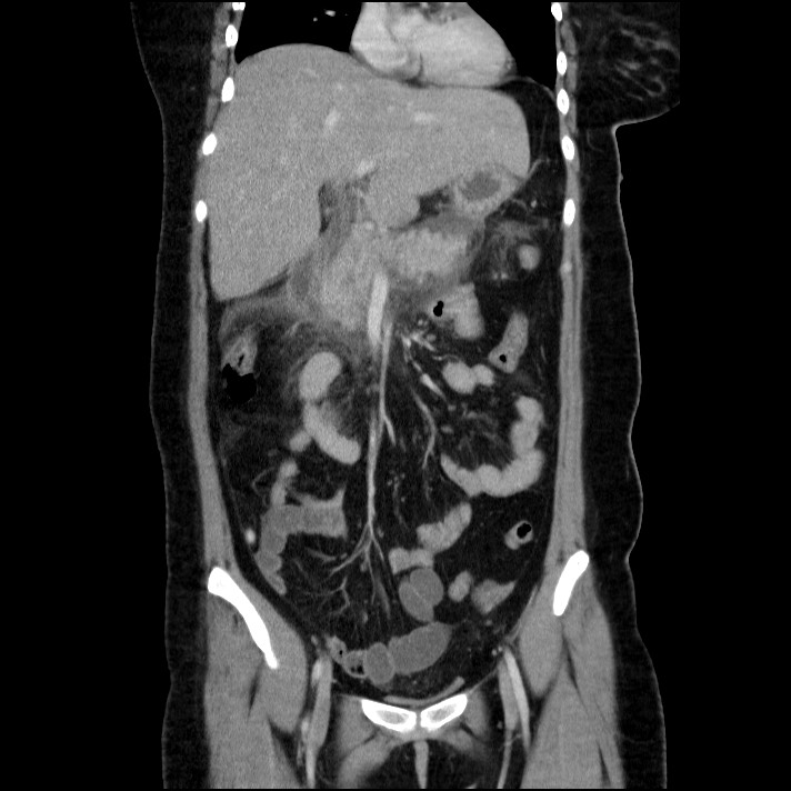 Acute pancreatitis (Radiopaedia 69236-79012 Coronal C+ portal venous phase 46).jpg