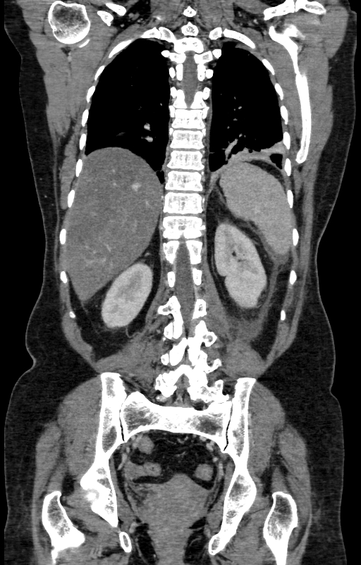 Acute pancreatitis (Radiopaedia 80007-93285 Coronal C+ portal venous phase 120).jpg