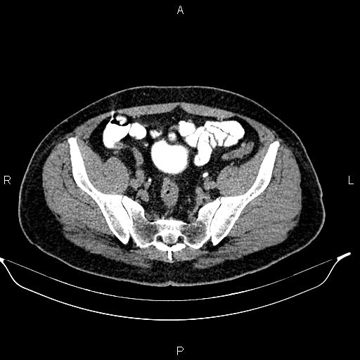 File:Acute pancreatitis (Radiopaedia 85390-101010 Axial C+ delayed 78).jpg