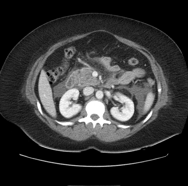Acute pancreatitis - Balthazar E (Radiopaedia 29016-29377 Axial C+ portal venous phase 28).png