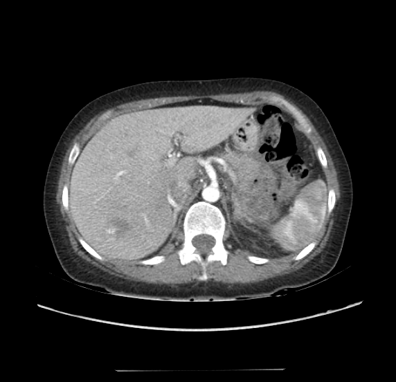 File:Acute pancreatitis - Balthazar E - post ERCP (Radiopaedia 27562-27772 Axial C+ arterial phase 13).png