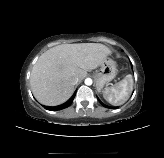 File:Acute pancreatitis - Balthazar E - post ERCP (Radiopaedia 27562-27772 Axial C+ arterial phase 7).png