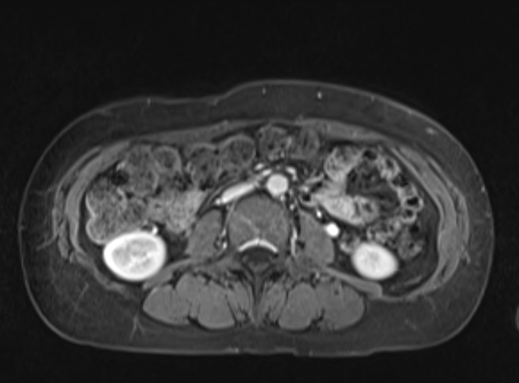 File:Acute pancreatitis - Balthazar E - post ERCP (Radiopaedia 27562-27778 F 68).png