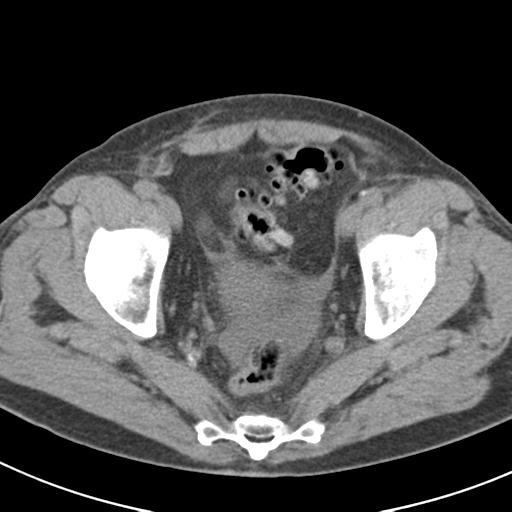 File:Acute pancreatitis and walled-off necrosis (Radiopaedia 29888-30403 Axial non-contrast 68).jpg