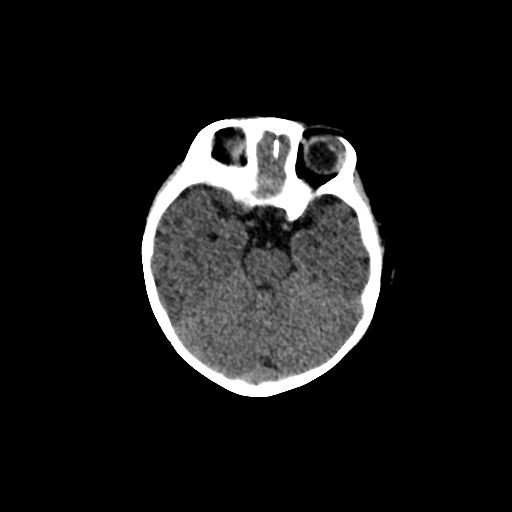 Acute phase of hemiconvulsion-hemiplegia epilepsy syndrome (Radiopaedia 29309-29744 Axial non-contrast 36).jpg
