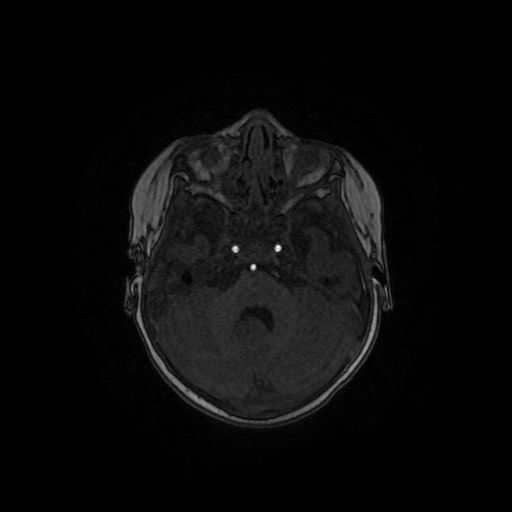 Acute phase of hemiconvulsion-hemiplegia epilepsy syndrome (Radiopaedia 29309-29745 Axial TOF angiography 111).jpg