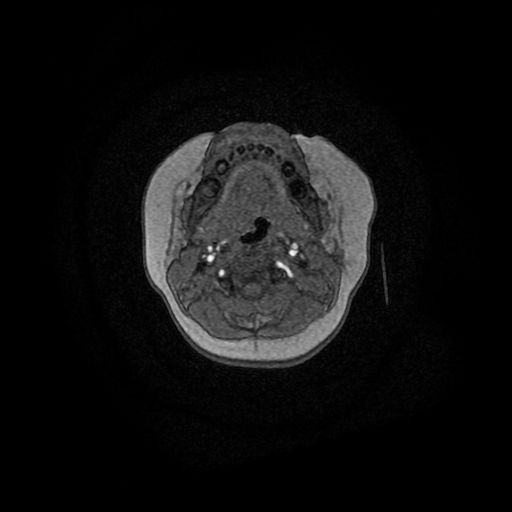 File:Acute phase of hemiconvulsion-hemiplegia epilepsy syndrome (Radiopaedia 29309-29745 Axial TOF angiography 181).jpg