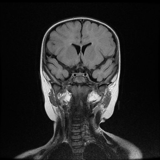 File:Acute phase of hemiconvulsion-hemiplegia epilepsy syndrome (Radiopaedia 29309-29745 Coronal FLAIR 9).jpg