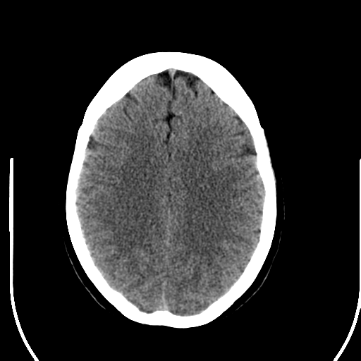 File:Acute pontine infarct from vertebral artery dissection (Radiopaedia 34111-35369 Axial non-contrast 20).png