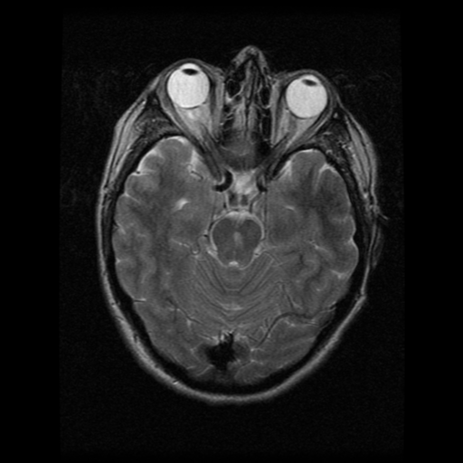 File:Acute pontine infarct from vertebral artery dissection (Radiopaedia 34111-35370 Axial T2 7).png