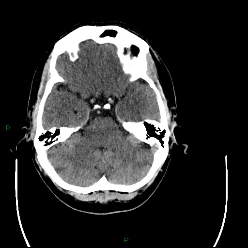 Acute posterior cerebral artery territory infarct (Radiopaedia 79329-92393 Axial non-contrast 29).jpg